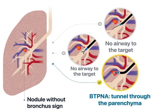 Schematic: a nodule without a bronchus sign, out of reach of needle and forceps through the airway, reached by BTPNA