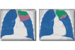 Hastalıklı (pembe) ve korunan (yeşil) segment: solda başlangıç, sağda tedaviden 6 ay sonra