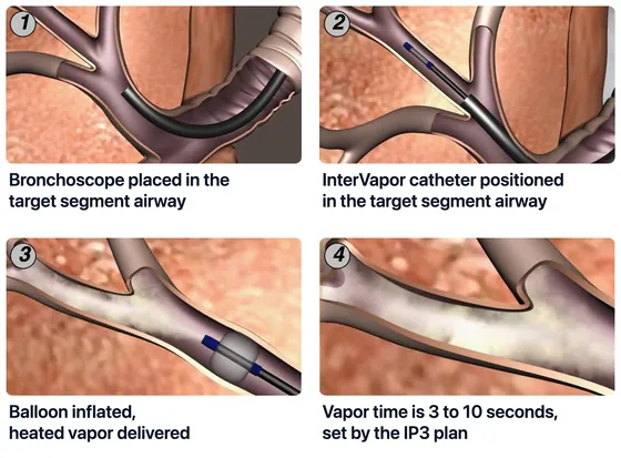 Schematic of the four procedure panels: bronchoscope, catheter, balloon and vapor, duration