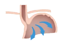 İşlevsel gastroözofageal flep valf